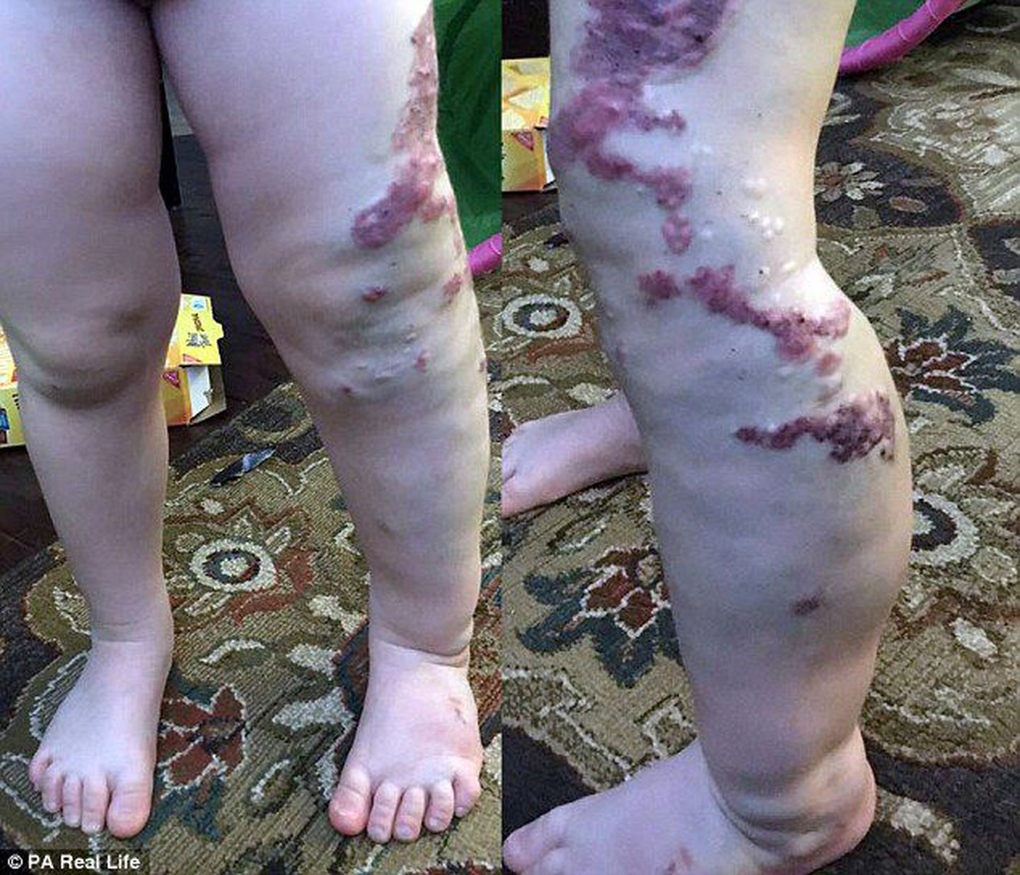 Suurenenud veresooned jalgadel on tüdrukul olnud juba sünnist saati.