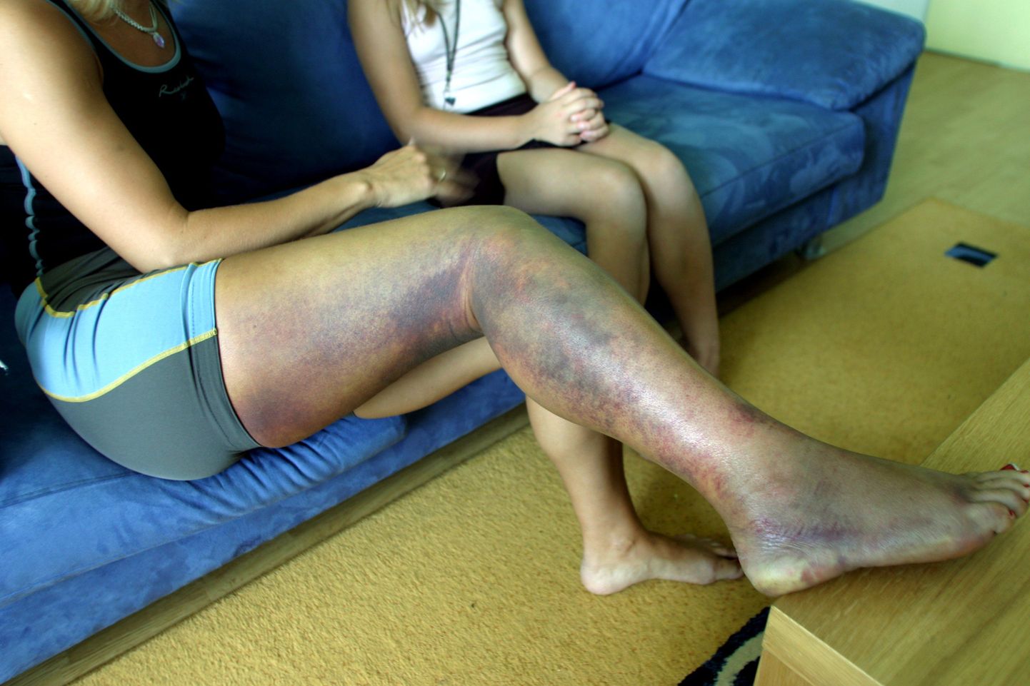 2005. aastal jäi rästikult hammustada saanud Kersti Läänemaa Haiglas vastumürgita ja ta viidi hiljem Mustamäe Haigla intesiivravi osakonda


tm/Foto TEET MALSROOS SL ÕHTULEHT