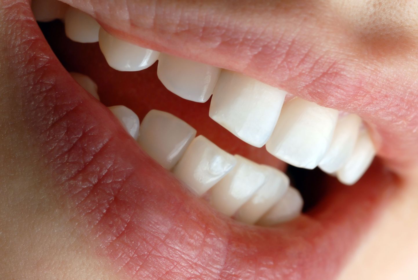 Uut ravivõtet peaks saama kasutada ka hammaste valgendamisel.