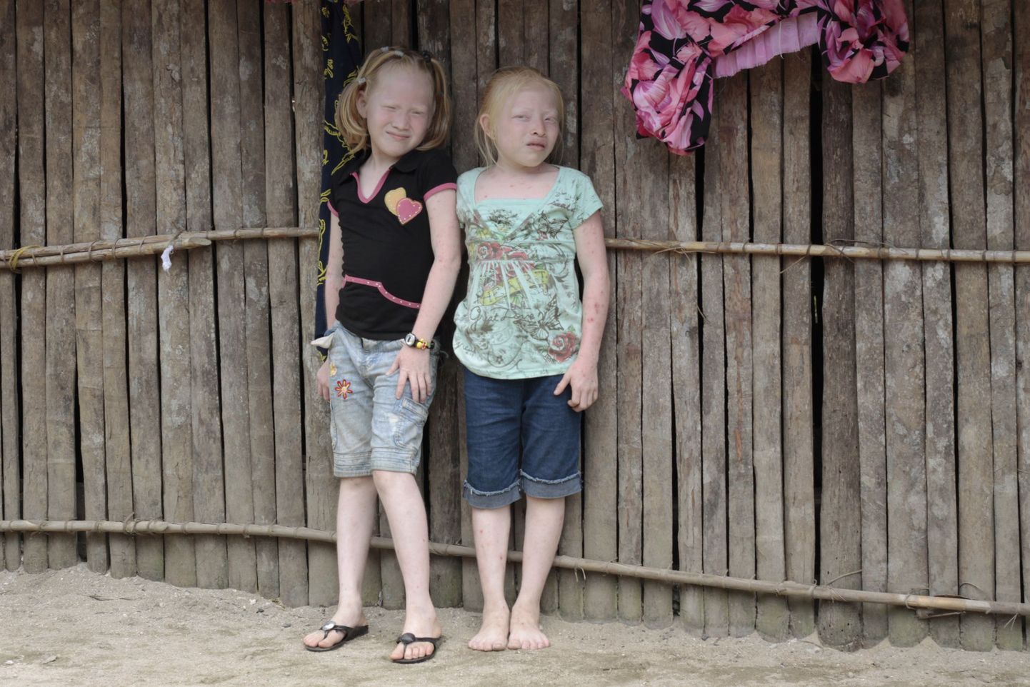 Kaks albiinotüdrukut