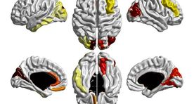 Uus meetod laseb autismi diagnoosida erakordselt vara, enne sümptomite ilmnemist
