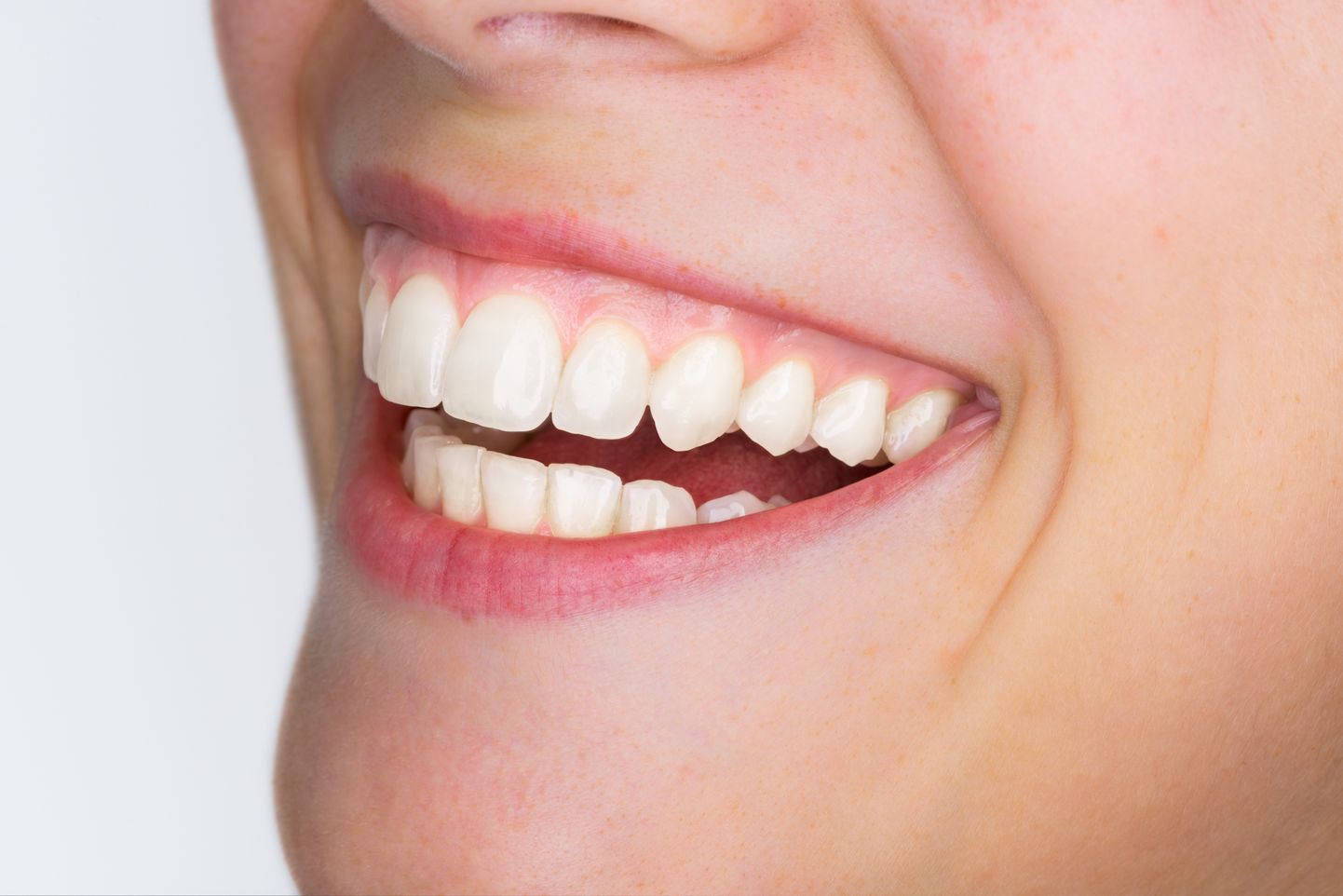 Hambaid saab hoida valgena teatud toite vältides.
