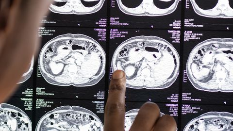 AVASTUS ⟩ Nende kahe psüühikahäire geneetiline taust on 70 protsenti ühine