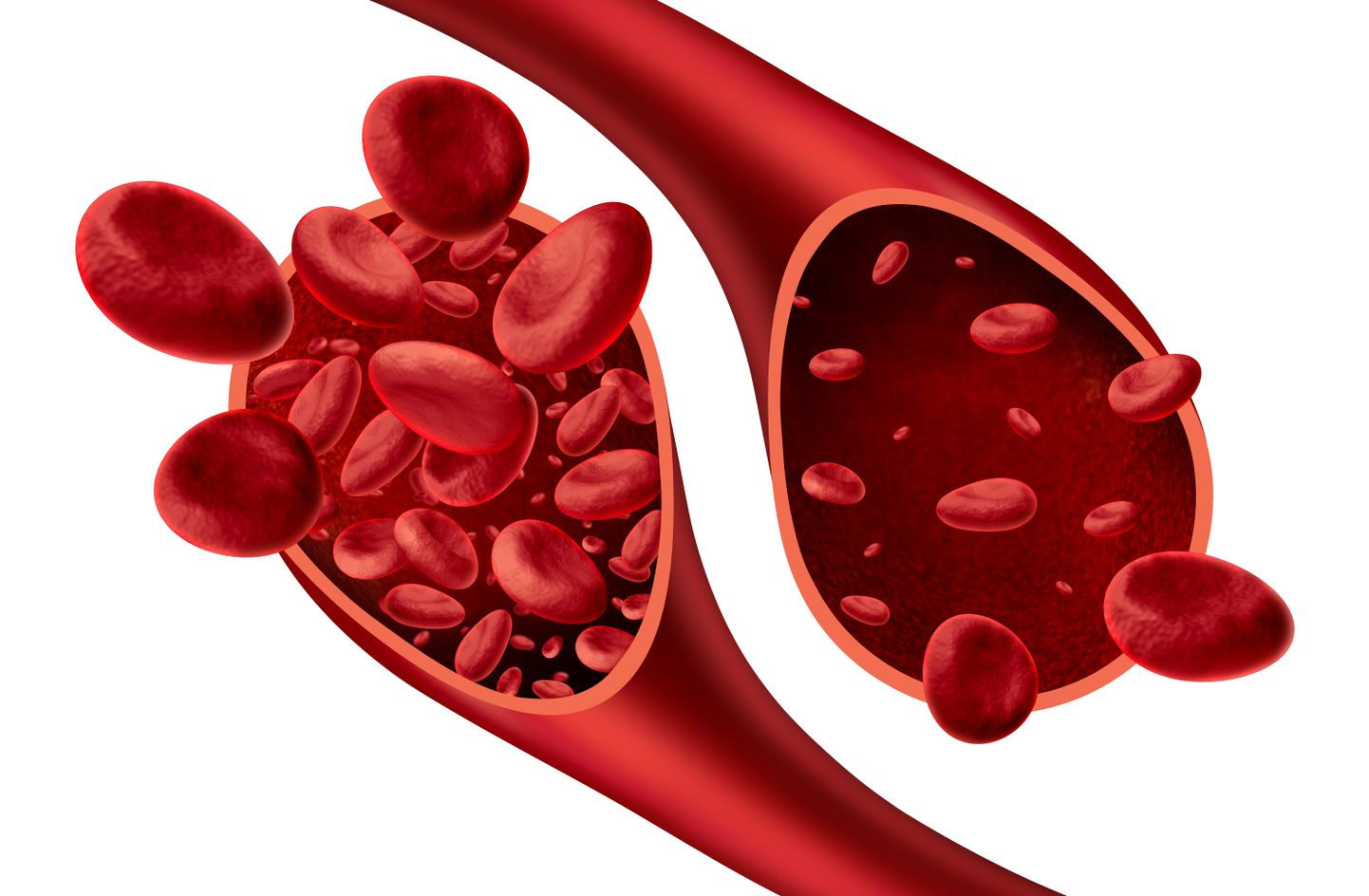 Aneemia korral on veres normaalsest vähem punavereliblesid ehk erütrotsüüte või nendes sisaldub normaalsest vähem hemoglobiini. Mõlemal juhul halveneb vere võime
transportida hapnikku kopsudest kudedesse. Pildil paremal normaalsest vähem punaliblesid