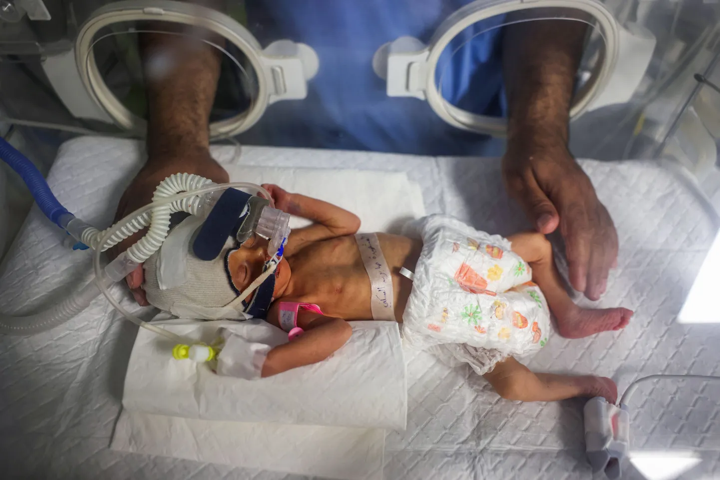 Iisraeli õhurünnakus hukkunud ema kõhust päästetud enneaegsena sündinud laps Rouh arstide hoole all Rafah’ haiglas. Tüdruk suri eile.