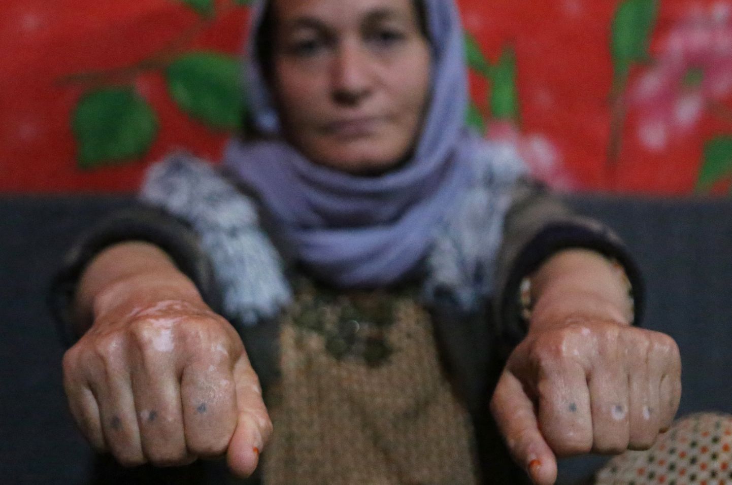 28. veebruar 2019. Jeziidi naine Baseh Hammo, kel õnnestus ISISe seksorjusest põgeneda, näitab vigastusi, mille albaanlasest võitleja talle piinamise kägus tekitas. Võitleja sundis naist suruma käed kuumale asfaldile, seejärel tallus ta saabastega naise kätel. Praegu elab Baseh telgis Dahukis, Iraagis. Vabaks pääsenud jeziidi naiste sõnul on sadu naisi, kes on jätkuvsalt kadunud ning kes ei pruugi kunagi koju tagasi pöörduda.
