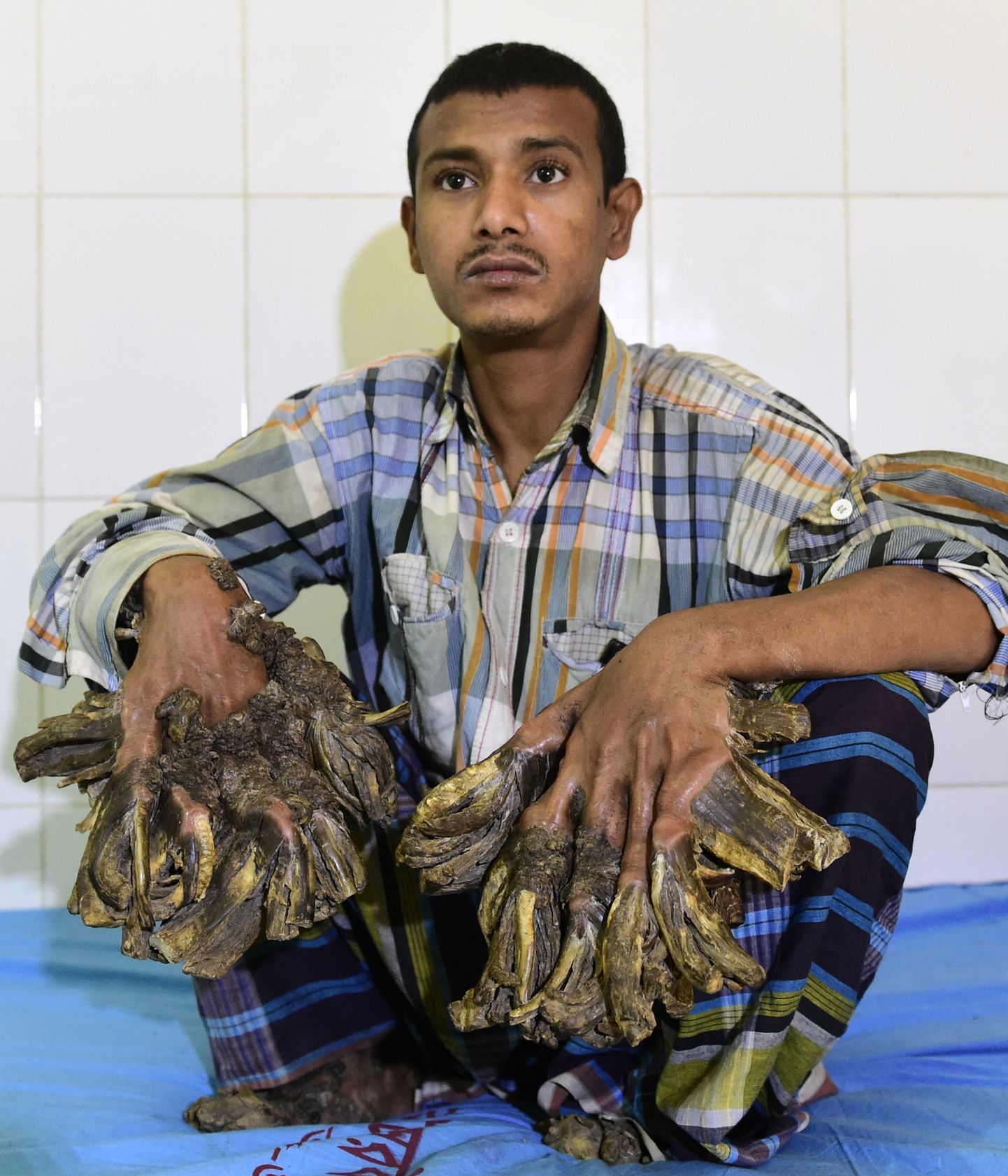 Bangladeshis elav Abul Bajandar on harudlase haiguse tõttu tuntud kui puumees.