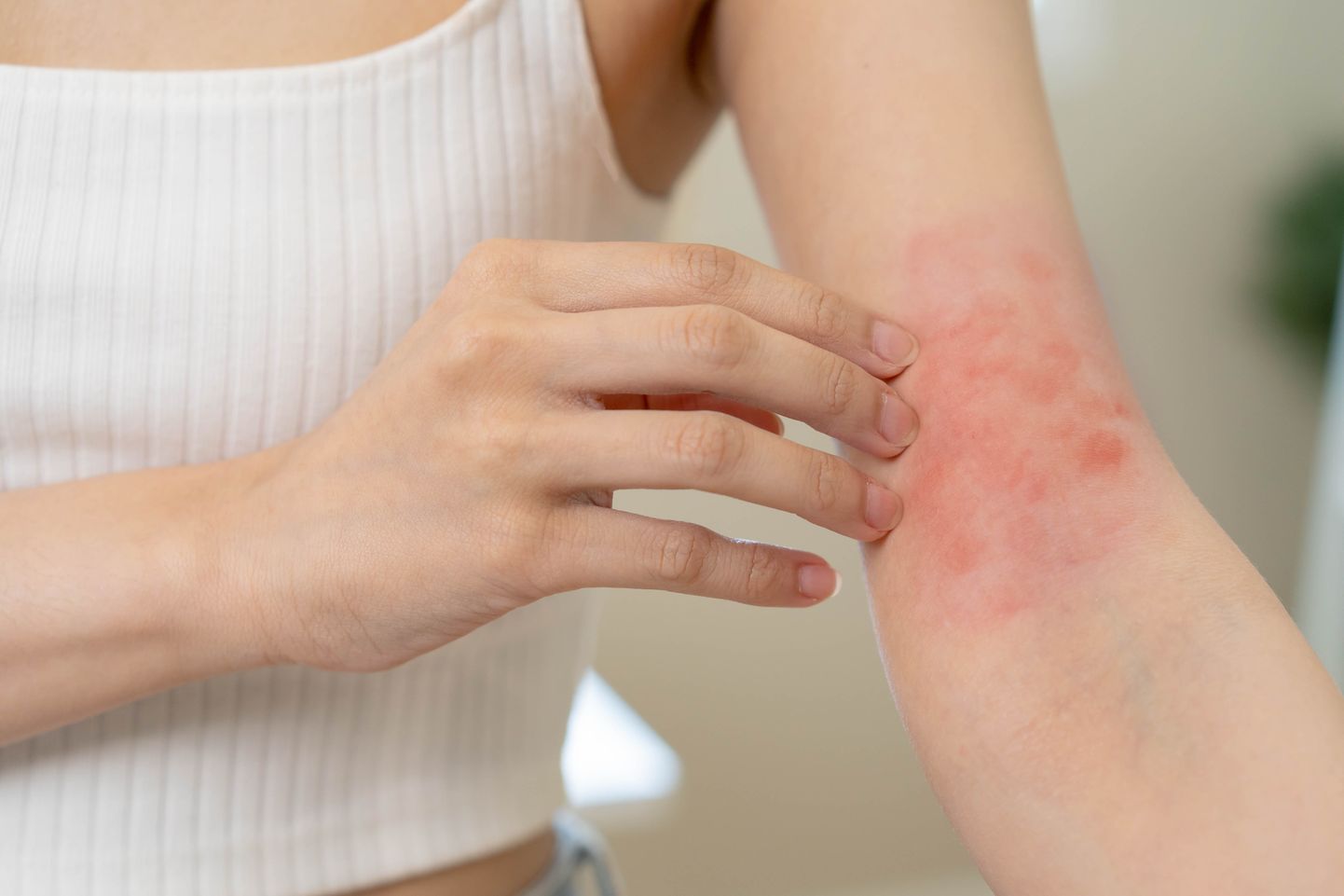 Atoopiline dermatiit esineb tihti käsivarre siseküljel või põlveõndlates.
