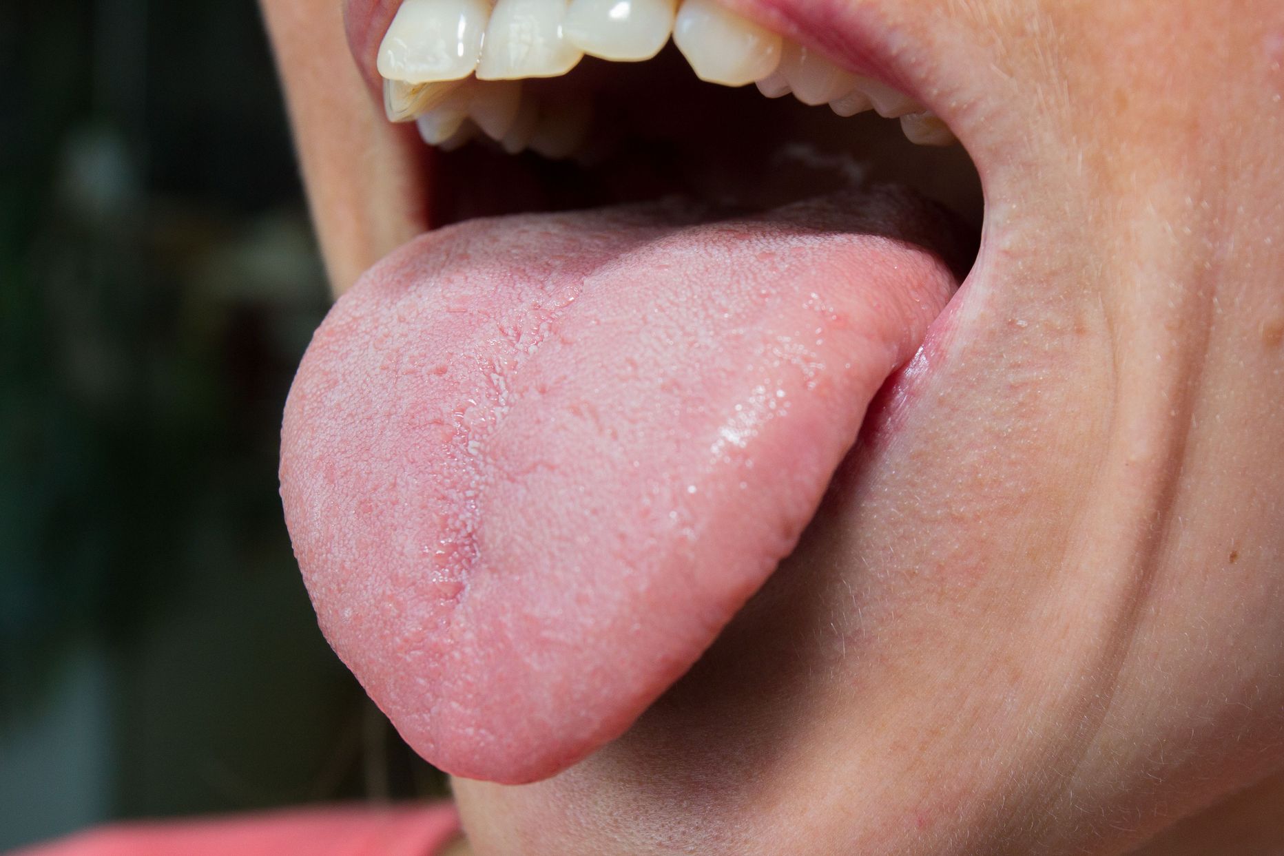 Suust tulev lõhn viitab sageli tõsisemale haigusele kui väike hambaauk.