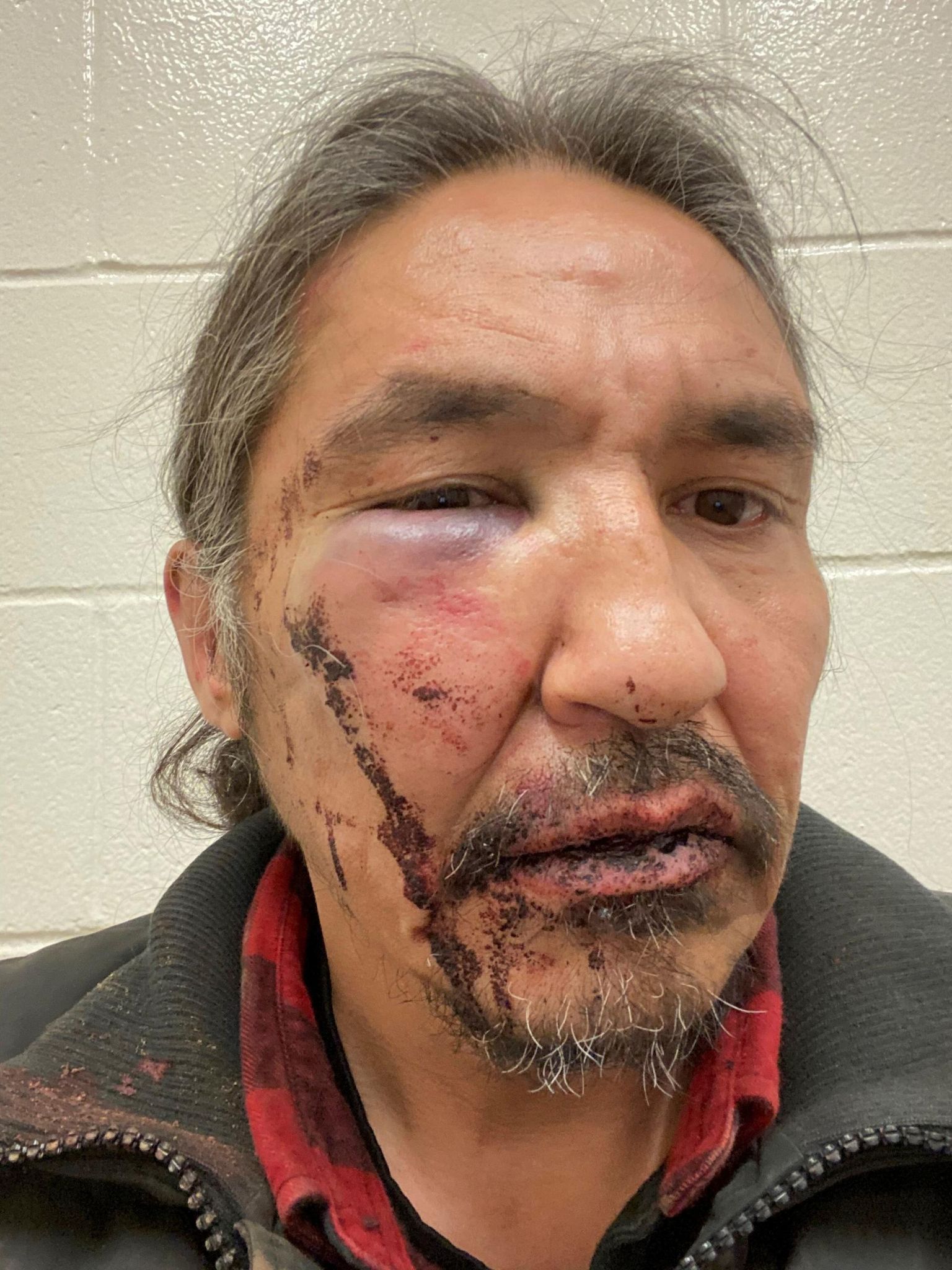 Kanada põliselanike pealik Allan Adam jagas pilti vigastustest, mille väidetvalt põhjustas teda löönud politseinik. 