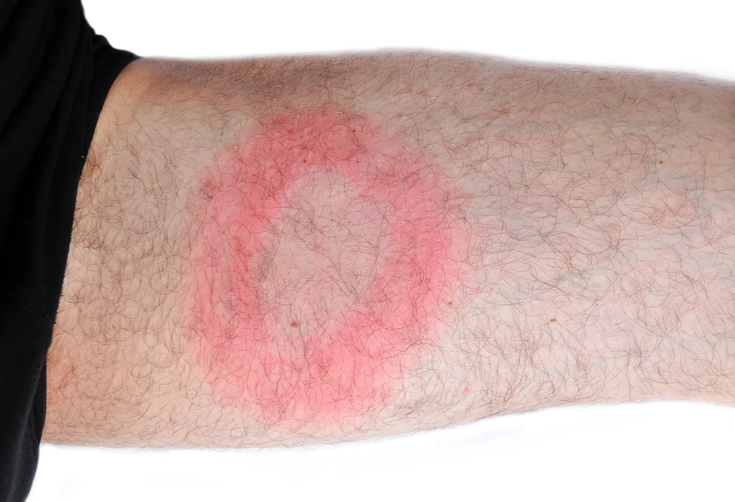 Puukborrelioosile omane punane sõõr.