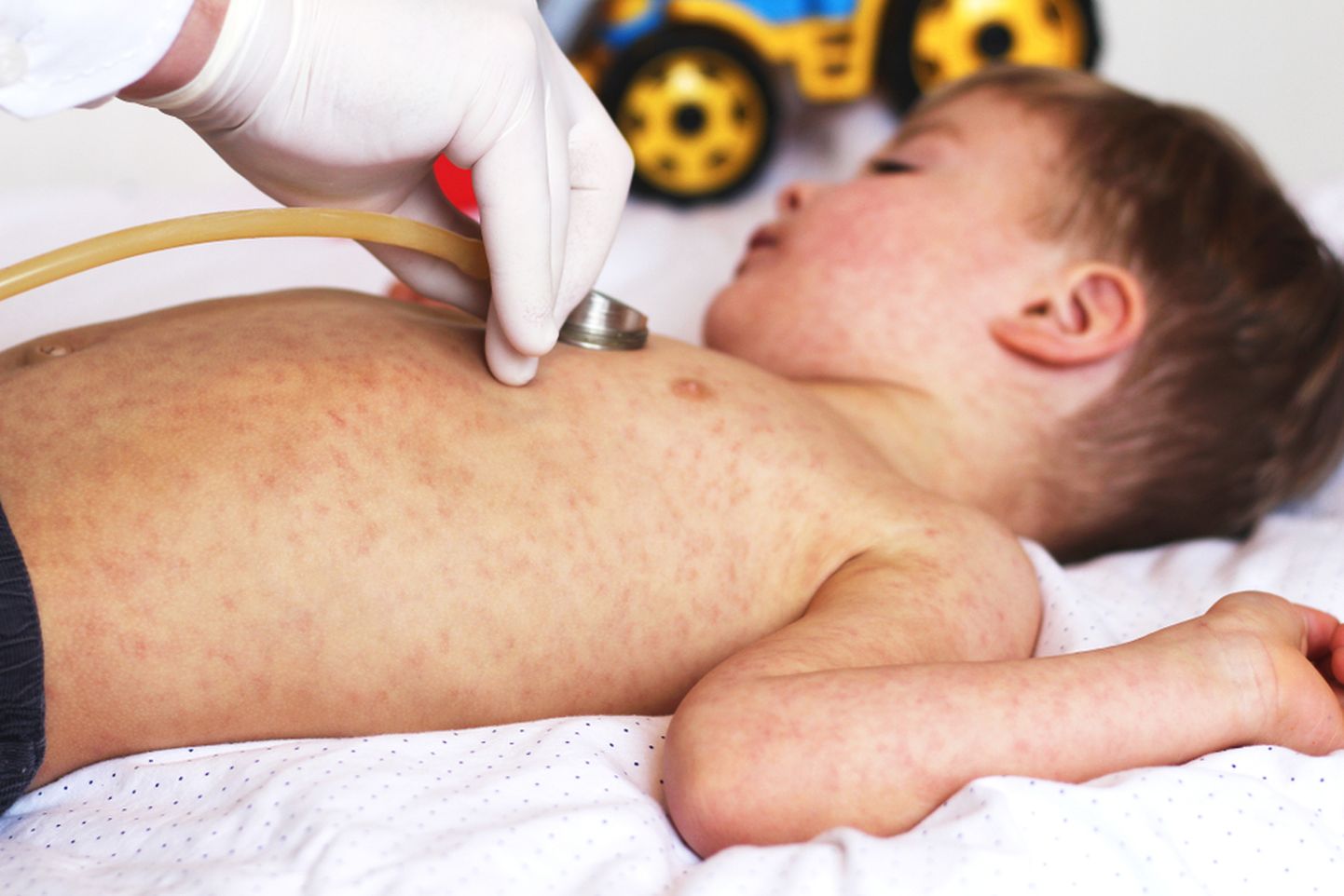 Leetrid on kõrge nakkavusega viirusliku päritoluga äge nakkushaigus.