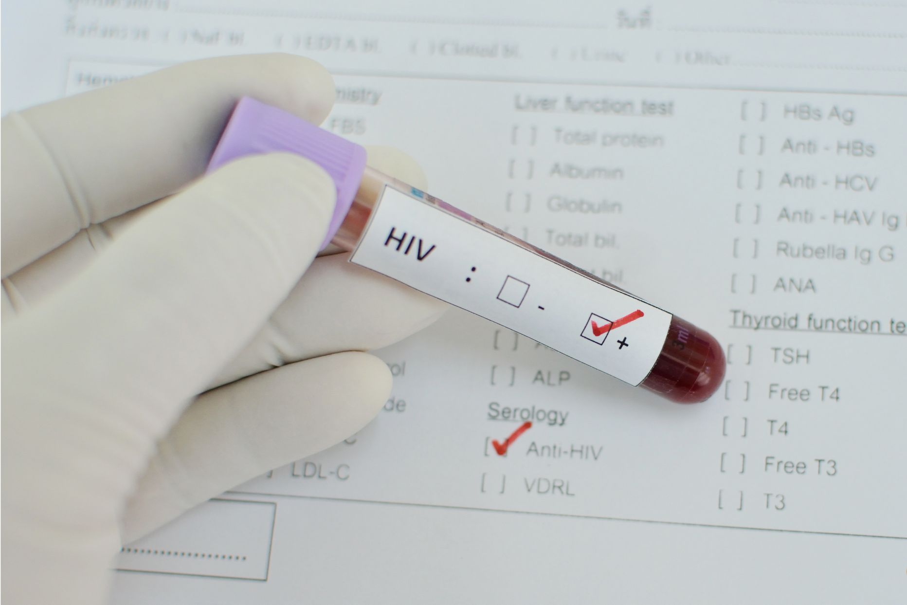 Тест анализ на вич. Анализ на ВИЧ. Анализ крови на СПИД. Исследование крови на ВИЧ.