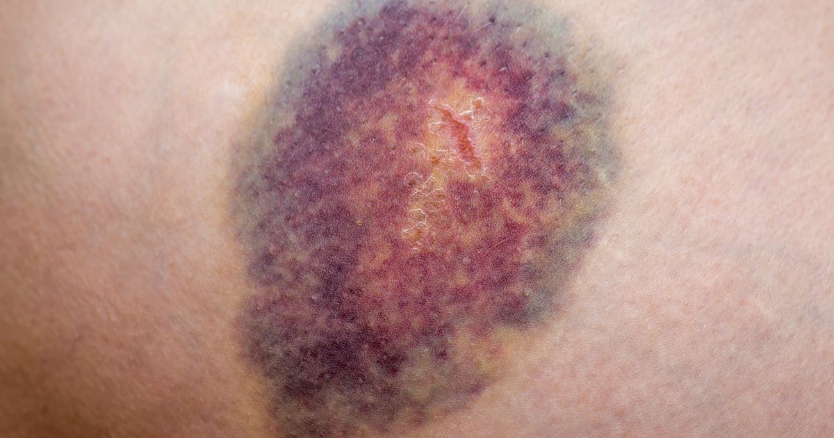 Clopidogrel Ja Alkoholi Clopidogrel Ja Alkoholi