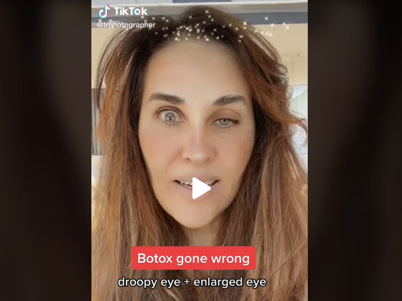 Tatiana Rezende jagab TikTokis oma kogemust seoses Botoxi süstimisega.