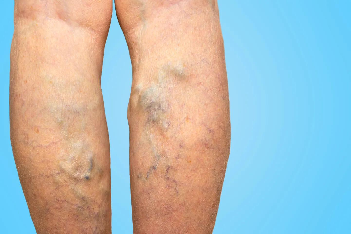 Varicose veins on a female legs