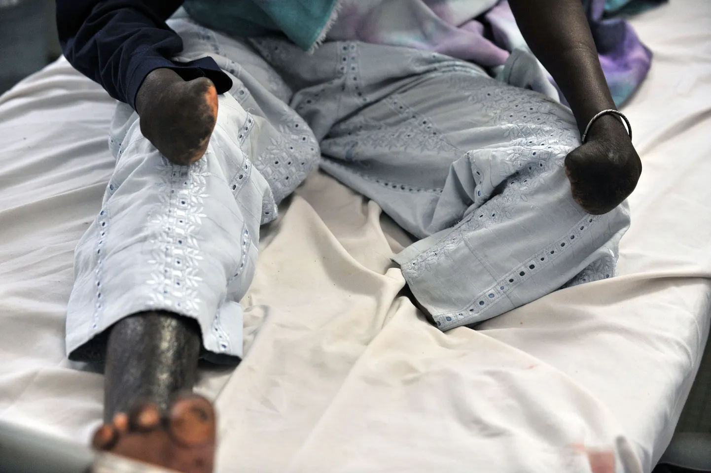 Leeprahaige mees Dakaris leepra uuringute keskuses.