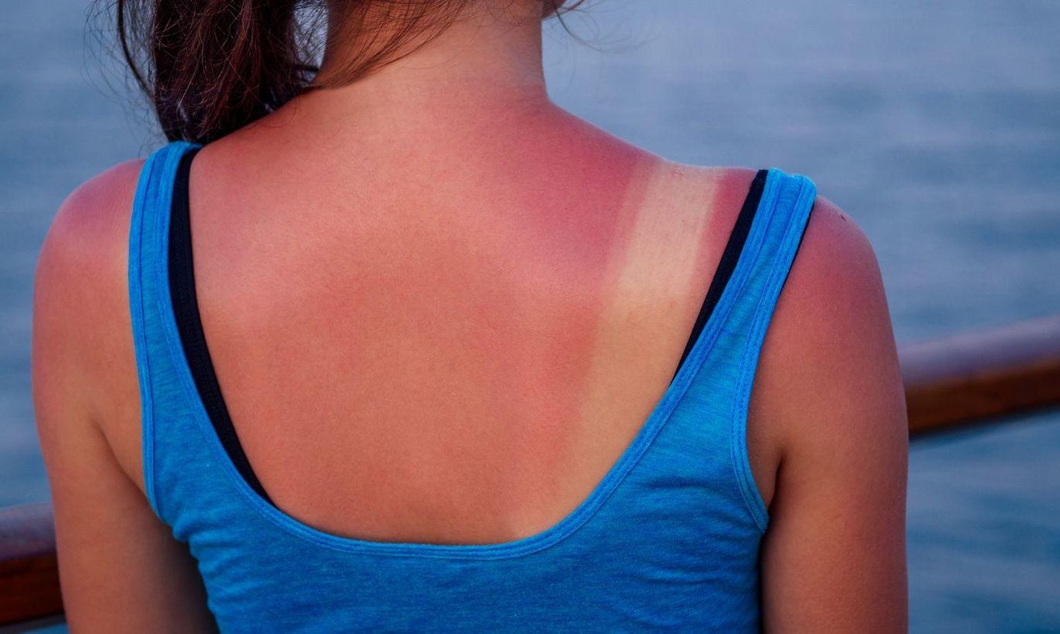 Päikesepõletust iseloomustab punetav ja tulitav nahk.