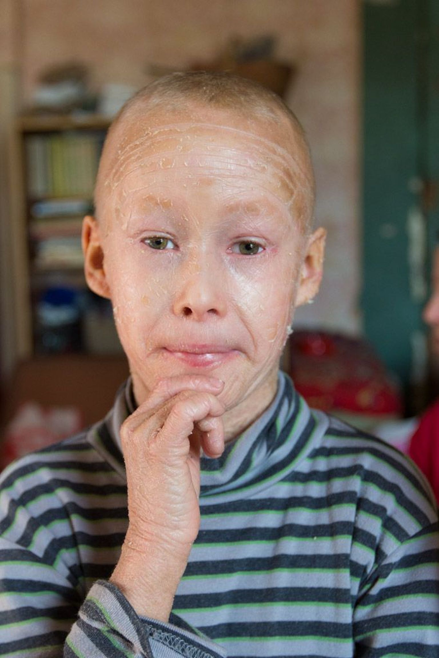 Valgamaa poiss Kaido, kellel on diagnoositud pärilik ja eluaegne nahahaigus ihtüoos.