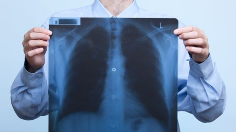Chest x-ray Chest x-ray
