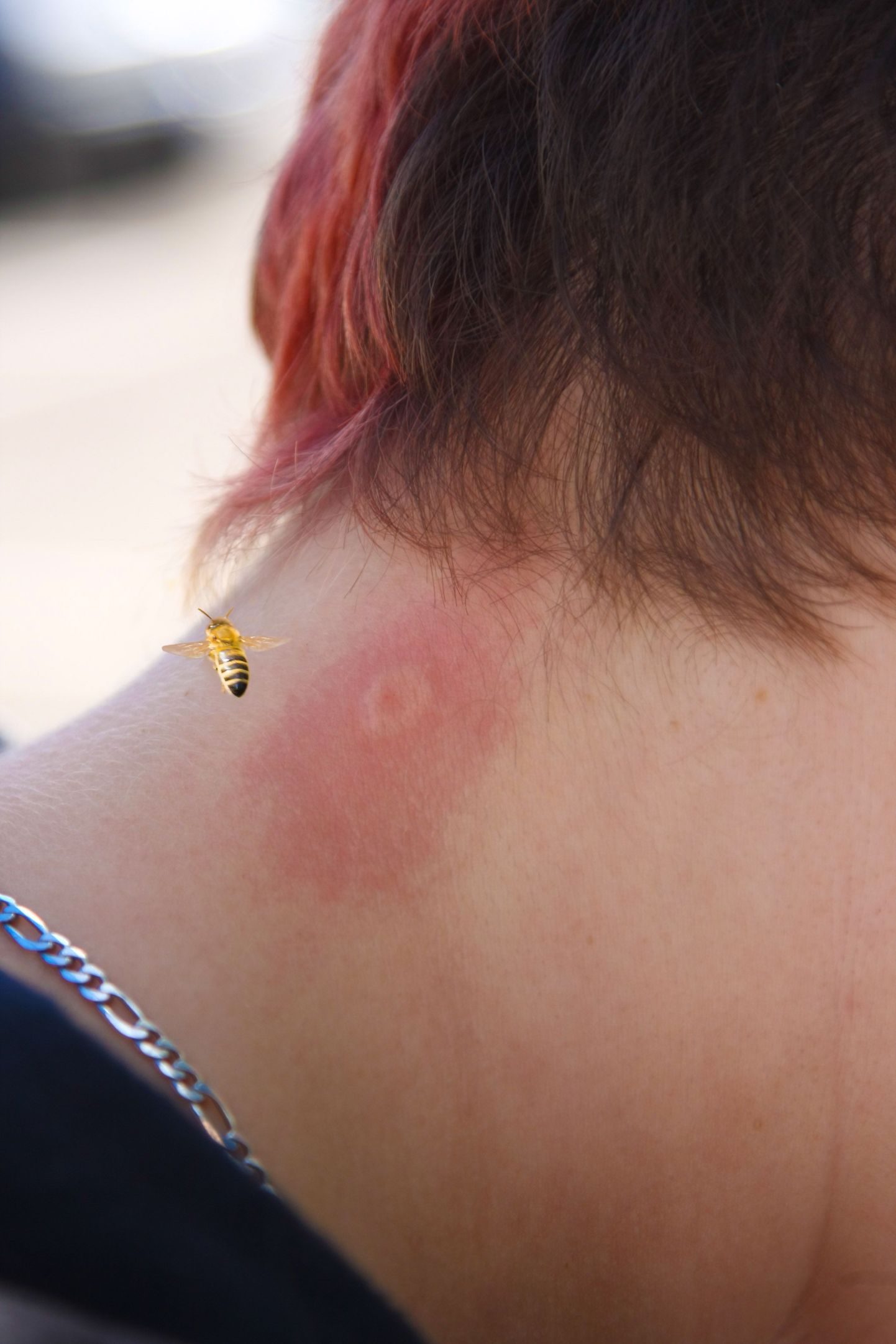 Mesilase-herilase nõelamine ei ole tavaliselt eluohtlik, kuid mõnel võib see põhjustada tugevaid allergilisi reaktsioone. Eriti ohtlik on saada nõelata näo või kaela piirkonda.