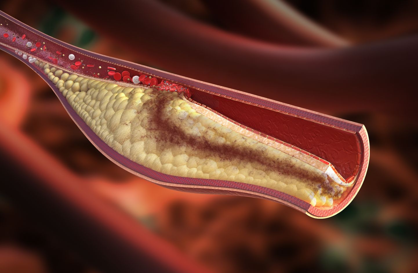 Halb (LDL) kolesterool kleepub veresoone seinte külge ja tekitab veresoonte lupjumist. Pilt on illustreeriv.
