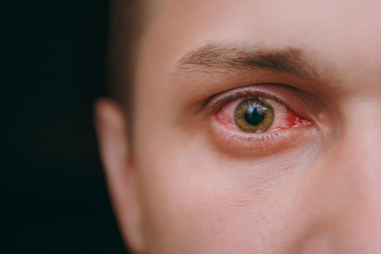 Silmade punetus ja sügelus võivad viidata omikroni uuele alamvariandile.
