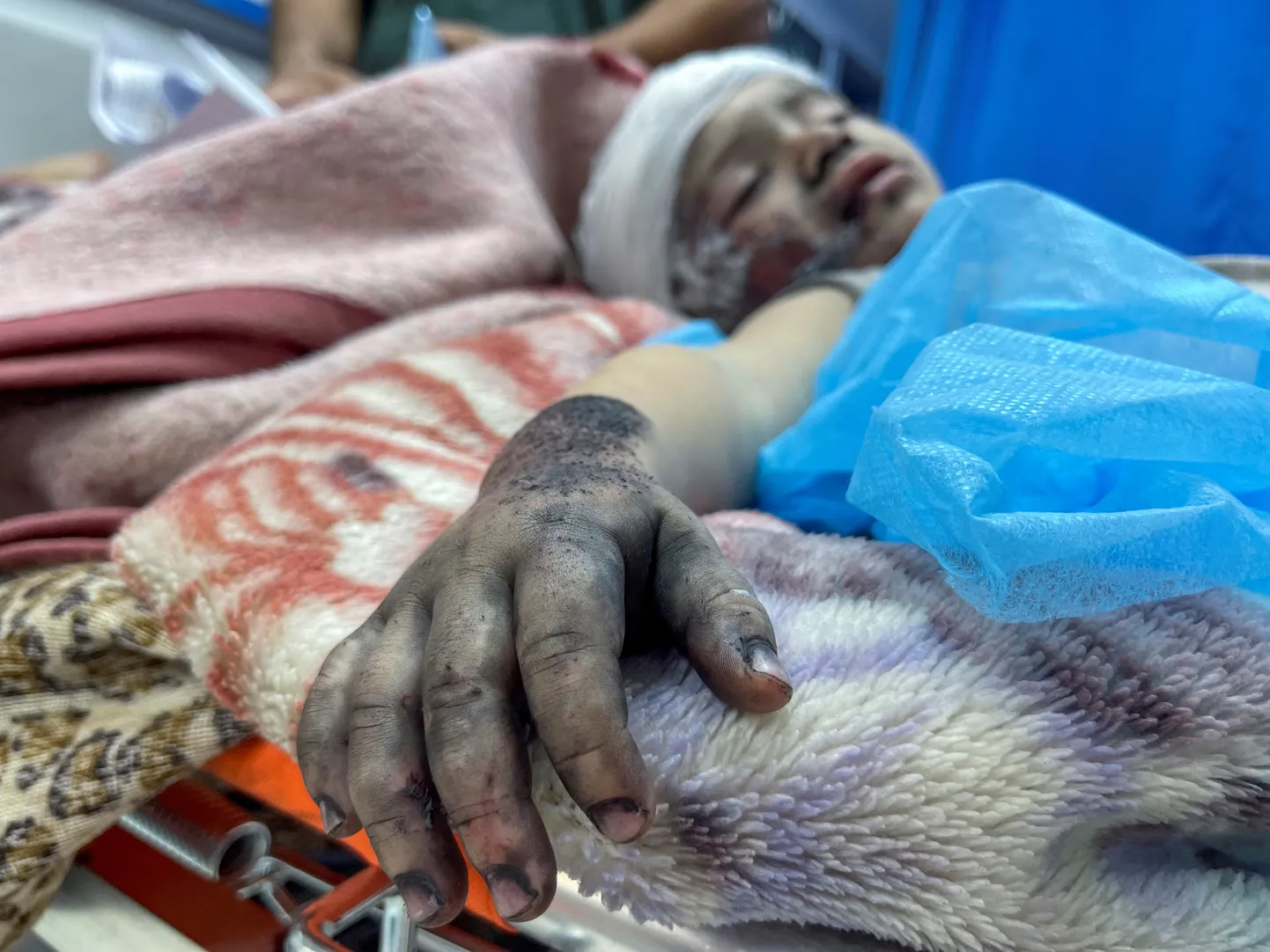 Iisraeli õhurünnakus haavata saanud palestiina poiss.