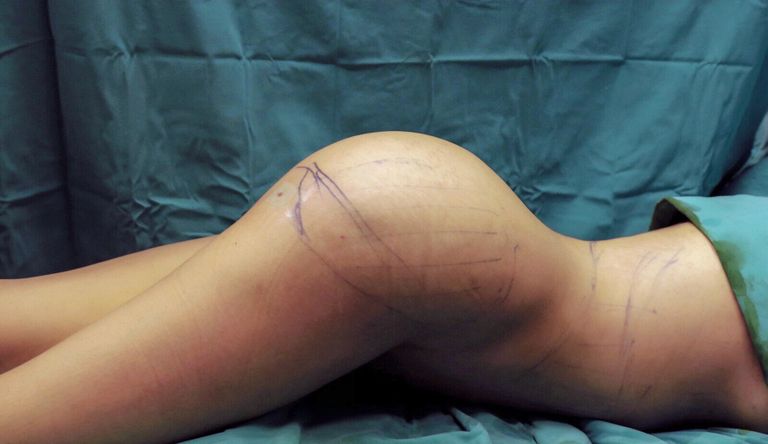Jennifer Pamplona ehk Kim Kardashiani teisiku tagumik paranemas implantaatide panekust.