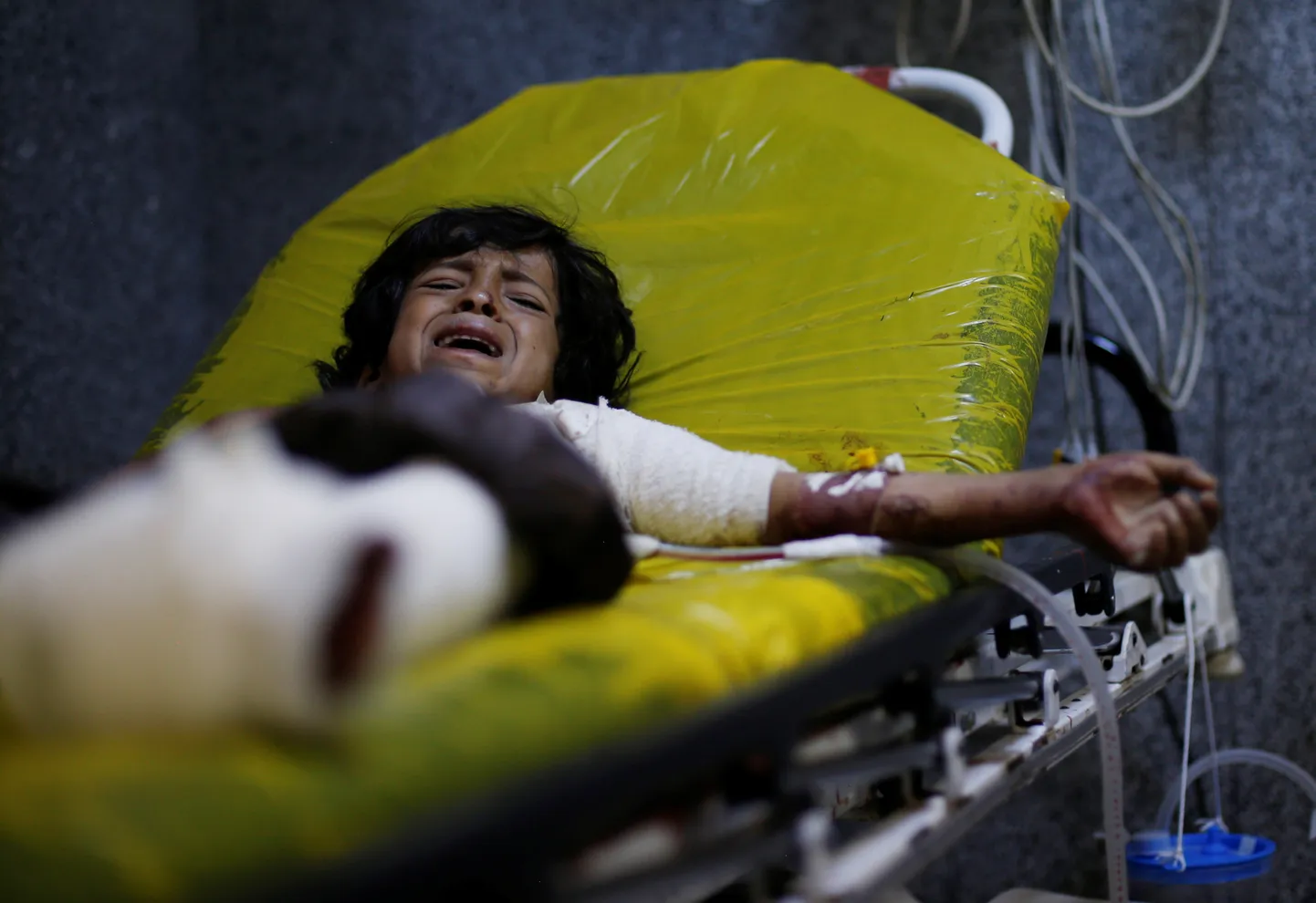 12-aastane Manea Abdul-Latif Marzouq nutab kanderaamil Jeemen pealinna Sanaa haiglas juuli keskel pärast vigastada saamist õhurünnakus riigi põhjaosa al-Jawfi provintsile.
