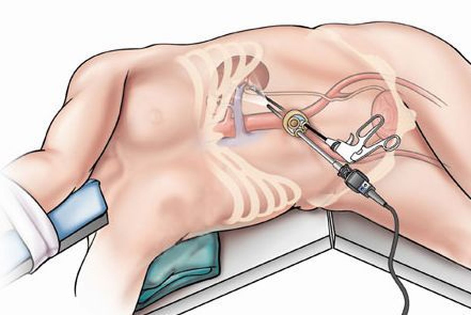 Uuelaadne operatsioon võimaldab organeid eemaldada naba kaudu