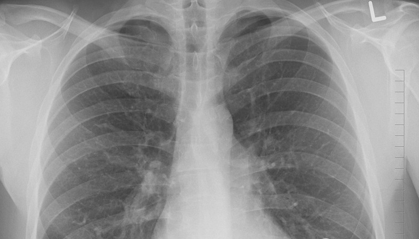 Cilvēka plaušu rentgens. Ilustratīvs attēls.