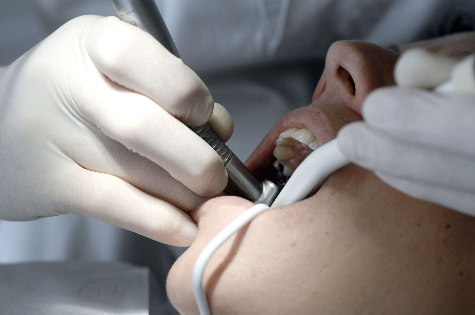 Hambapõletiku tõttu võib tekkida eluohtlik kogu keha põletik ehk sepsis.