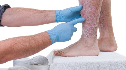 Psoriaas kimbutab paljusid. Psoriaas kimbutab paljusid.