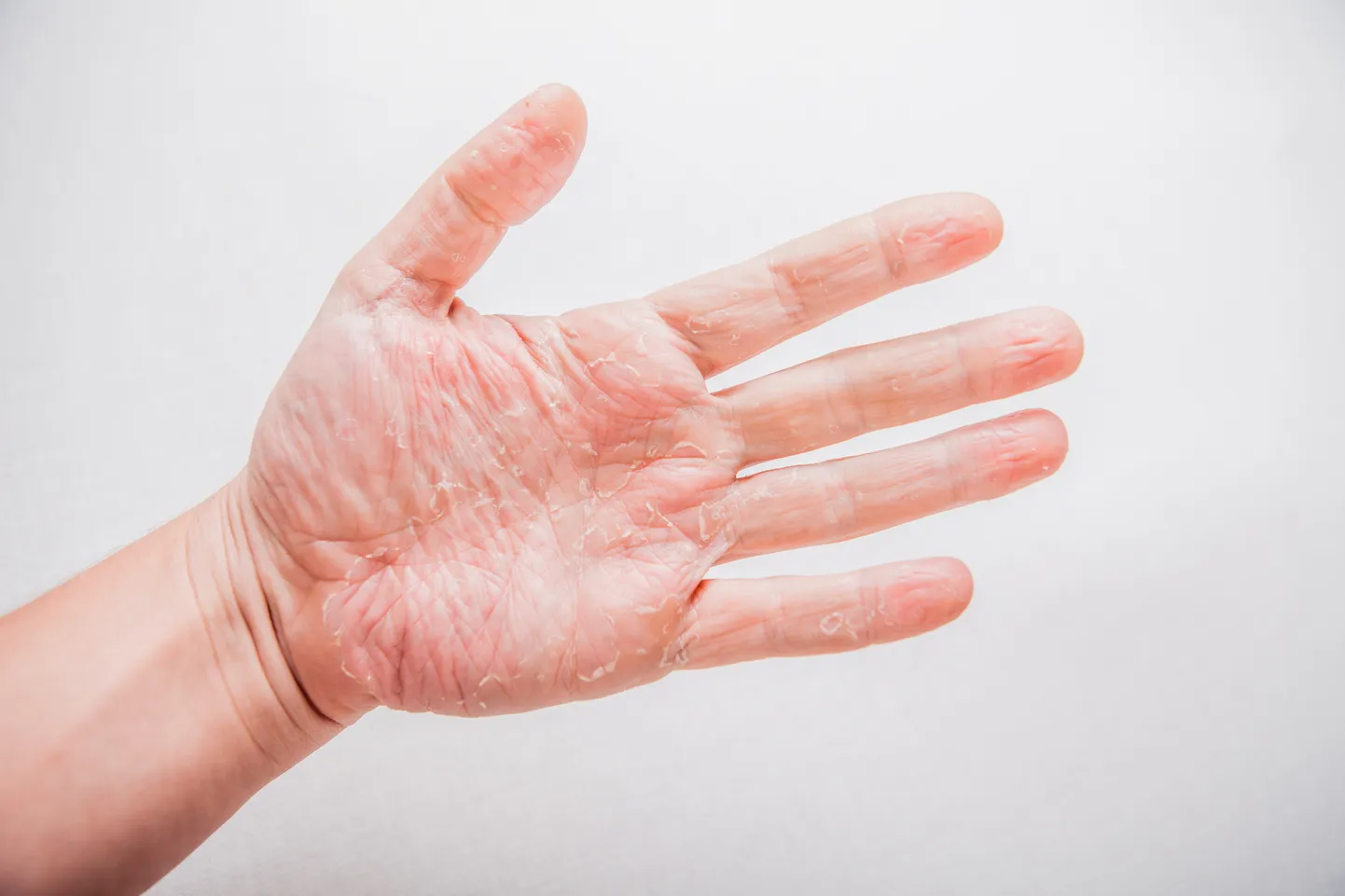 Peopesa ketendamine võib viidata psoriaasile.