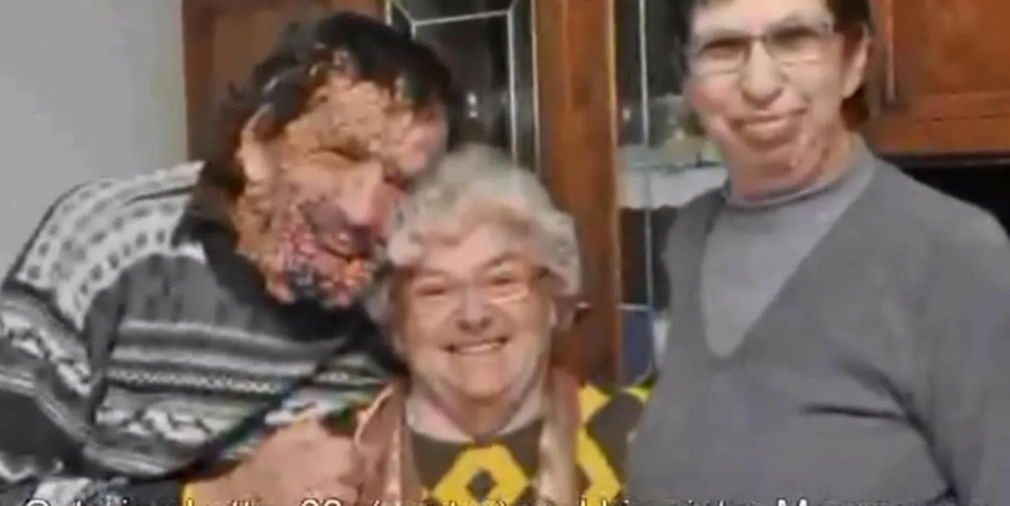 53-aastane Vinicio Riva (vasakul) kannatab esimese tüübi neurofibromatoosi all