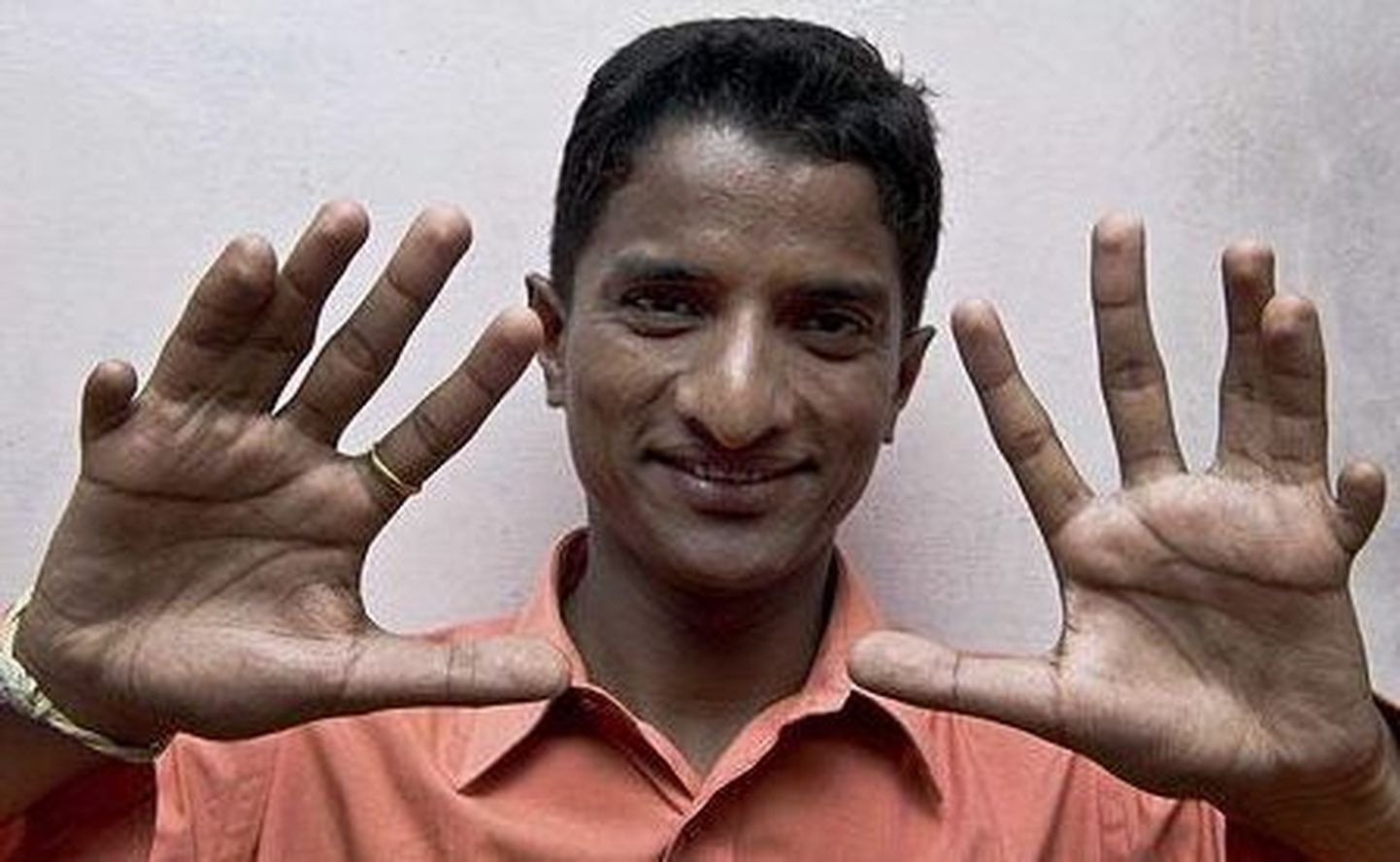 Hindul Heramb Ashok Kumthekaril on 12 sõrme ja 14 varvast