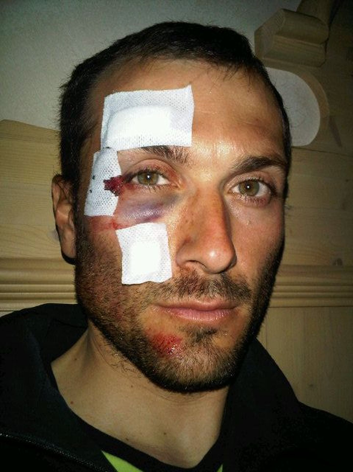 Ivan Basso nägu pärast haiglast kojujõudmist.