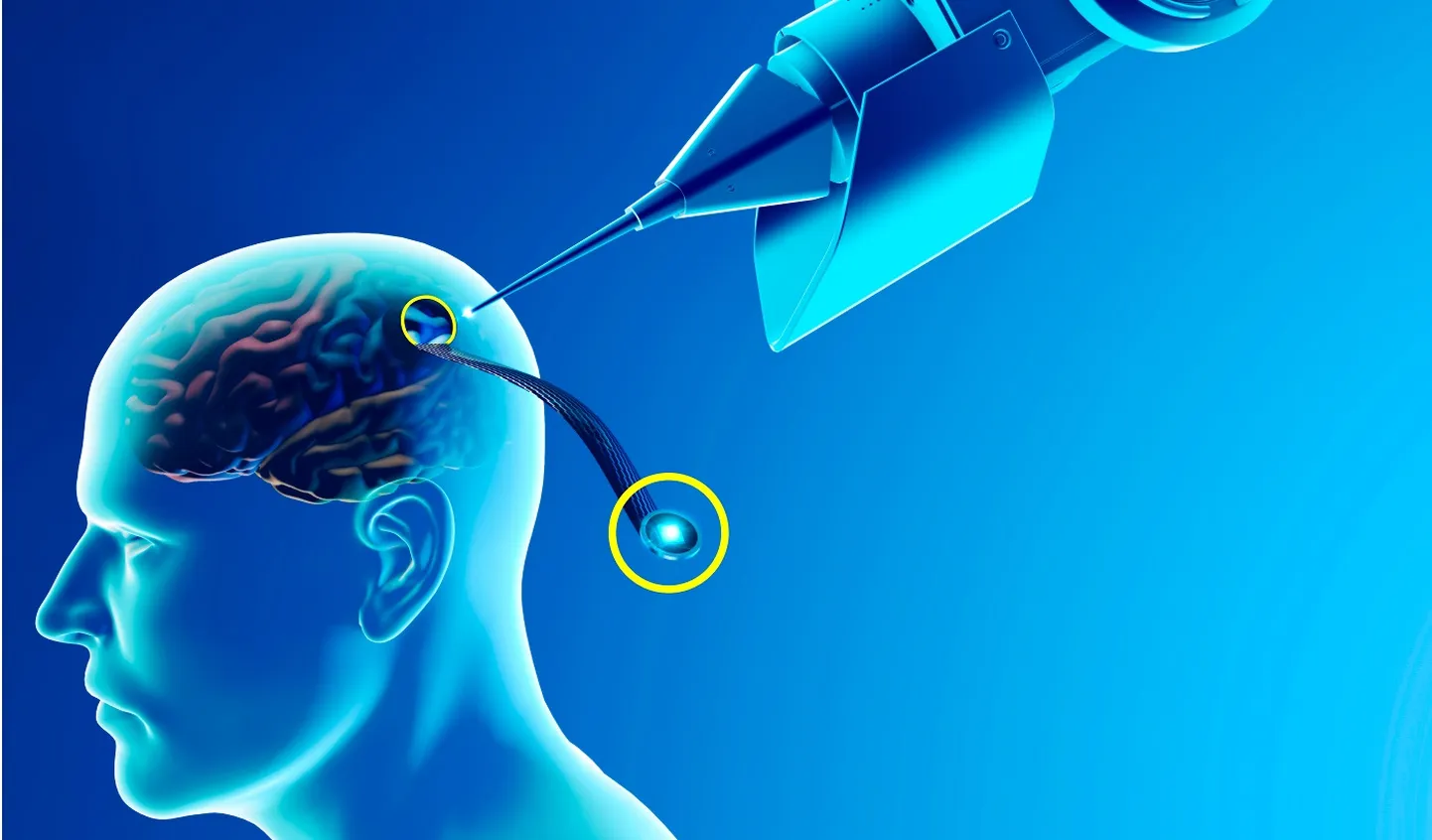 Neuralink soovib muuta oma ajuimplantaatidega maailma.