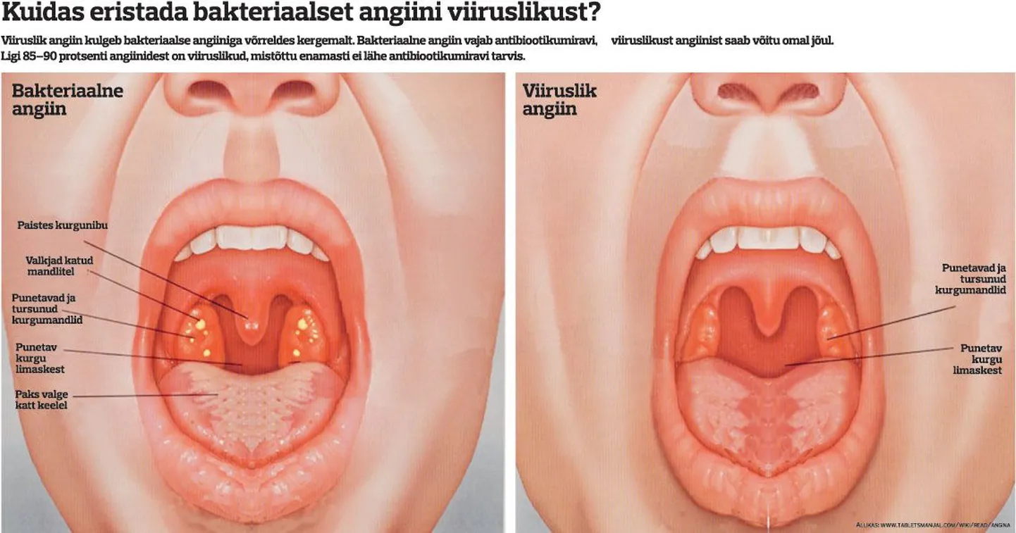Kuidas eristada bakteriaalset angiini viiruslikust?