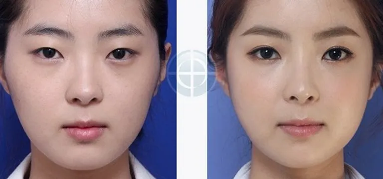 Koreas on populaarne iluoperatsioon topeltlaugude tekitamine.
