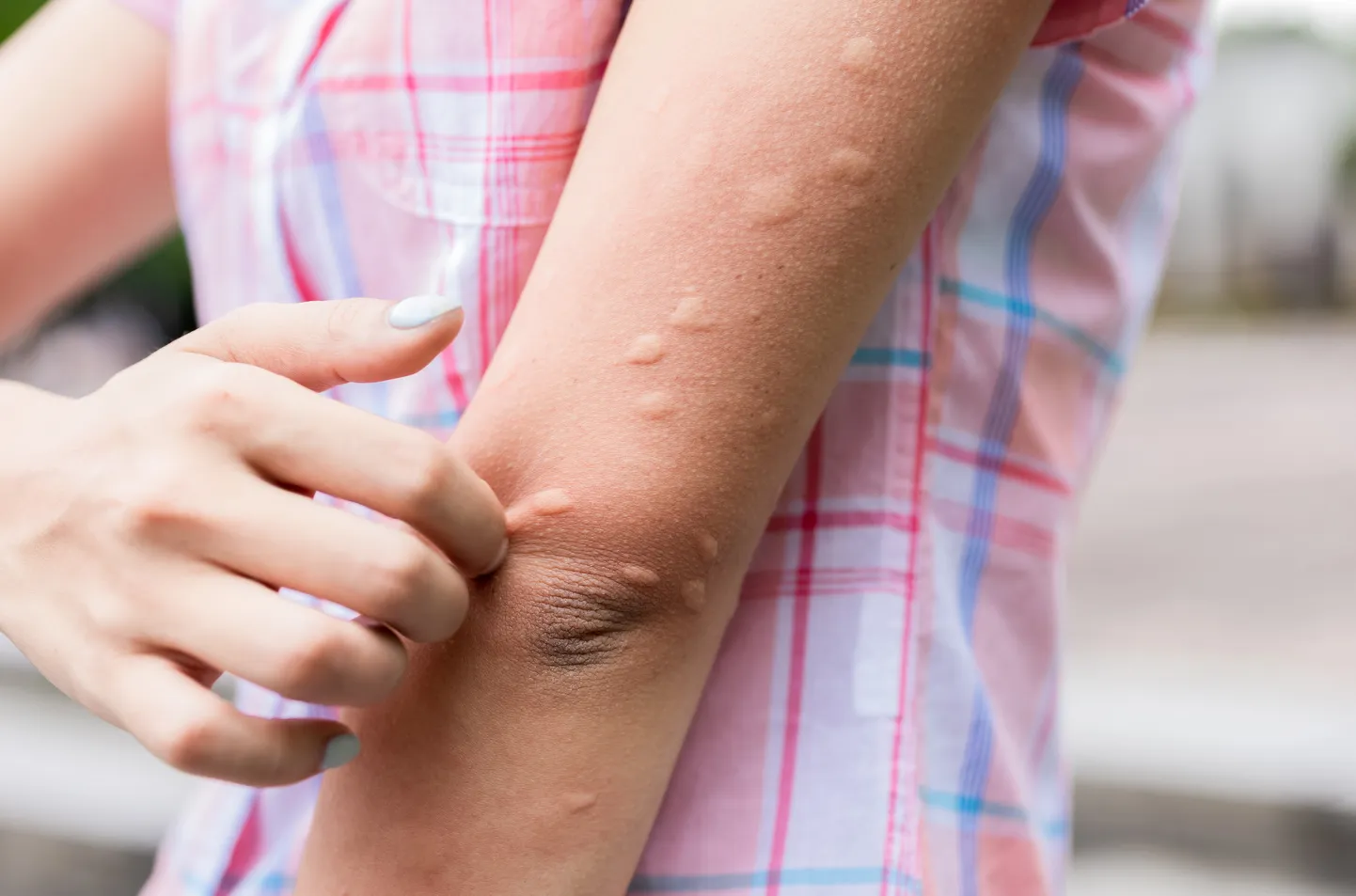 Белки, содержащиеся в слюне комаров, могут вызвать аллергическую реакцию.