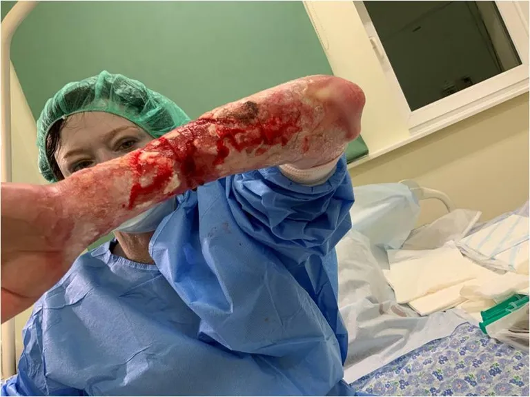 Natalja Šebunova haavandite tõsidusest annab aimu see foto.