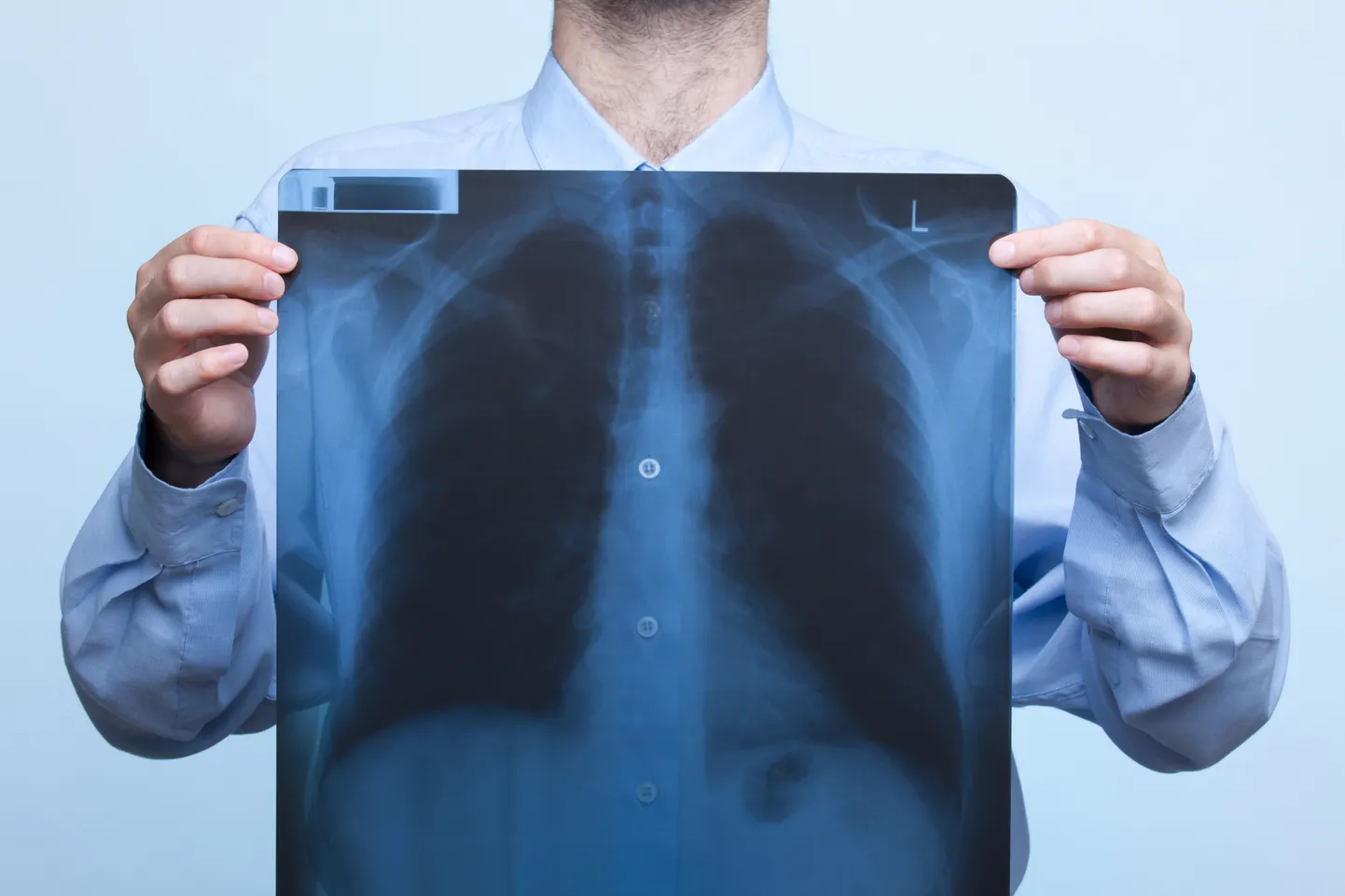 Chest x-ray