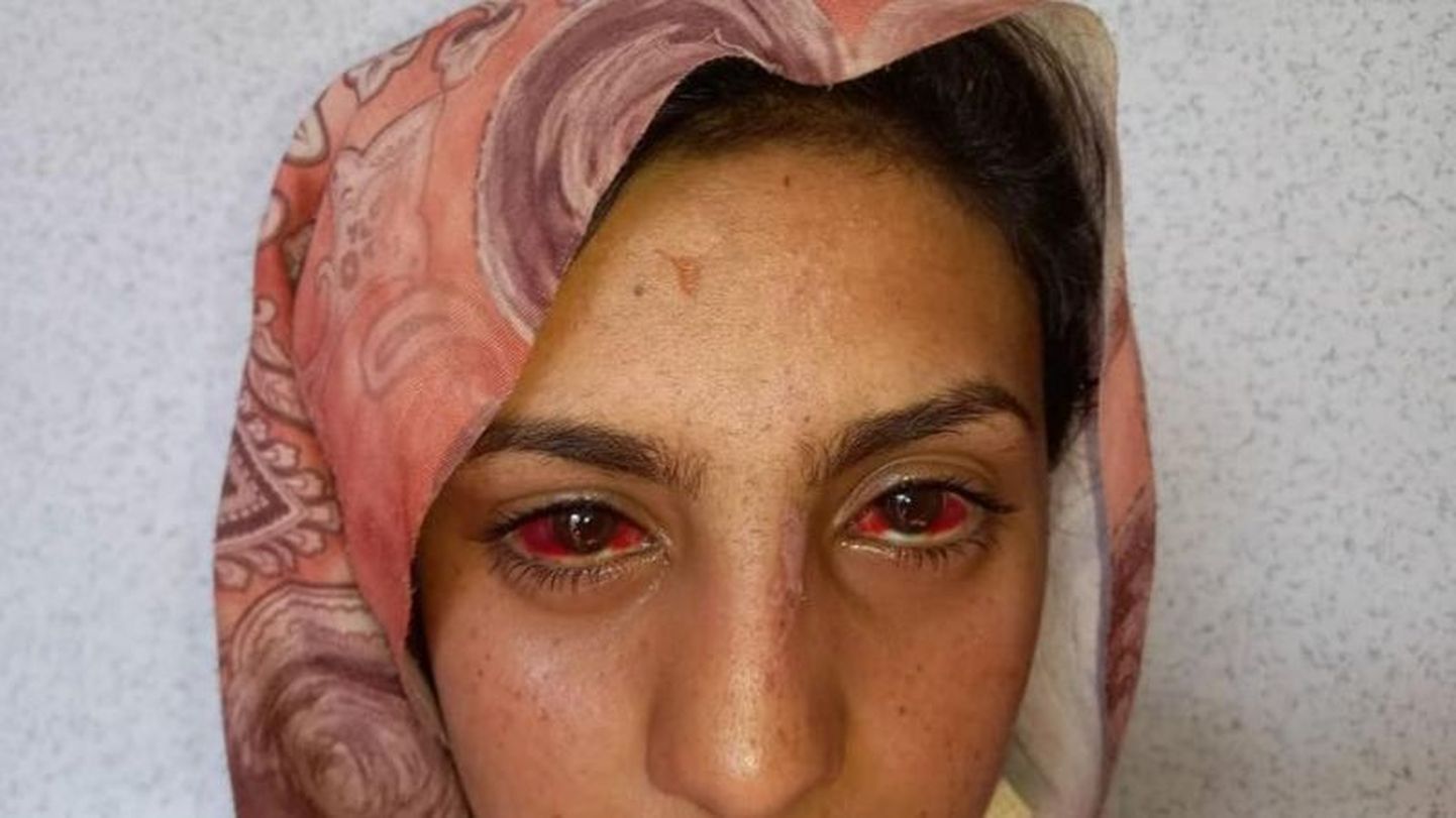 Зрение этой афганской женщины восстановилось после травмы, но лечения ей пришлось ждать несколько дней.