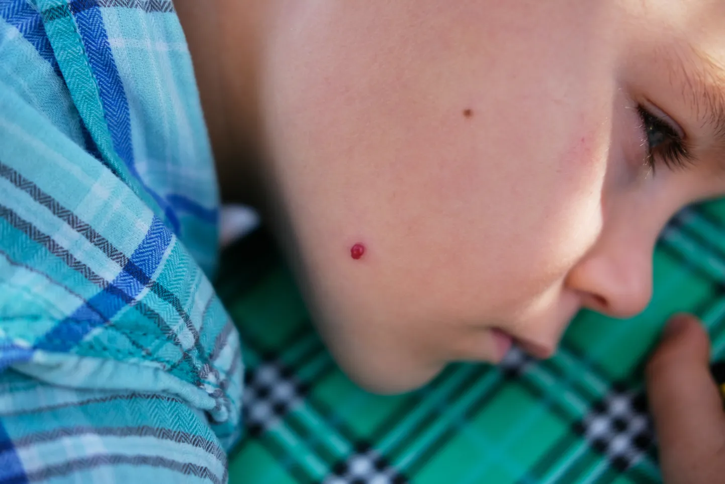 Hemangioom on veresoontest koosnev healoomuline kasvaja.