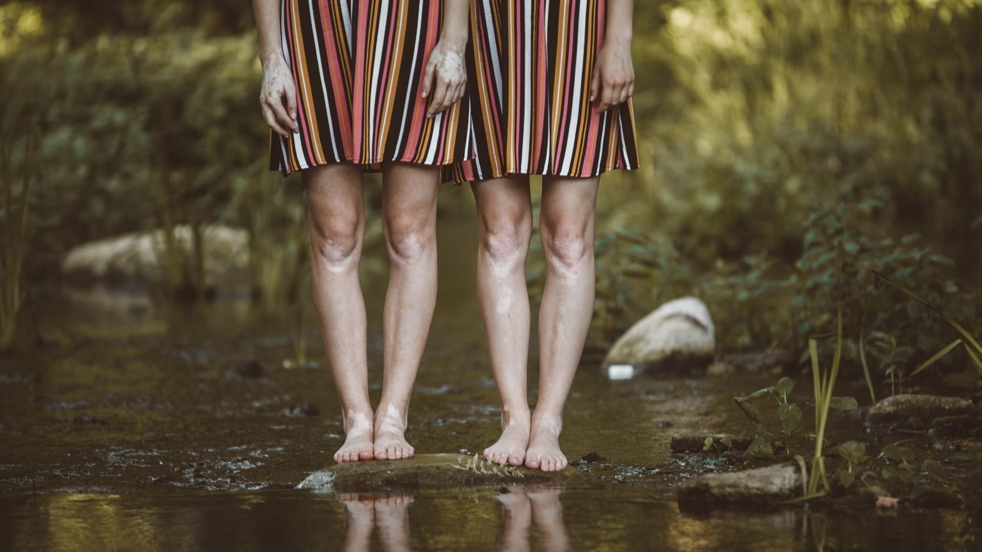 Kitijas Jurcikas "Vitiligo" fotoprojekts - modeles Lizete un Elīza