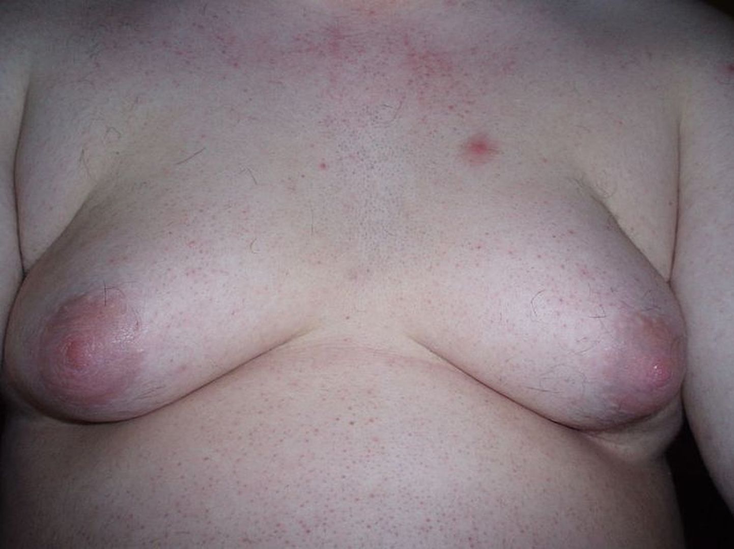 Kanep tekitab meestel rindade suurenemise?