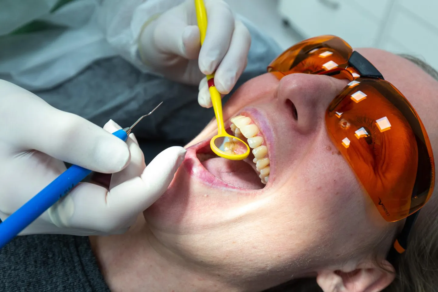Tervisekassa plaanib 2024. aastal hambaraviteenuseid rahastada enam kui 103 miljoni euro eest.