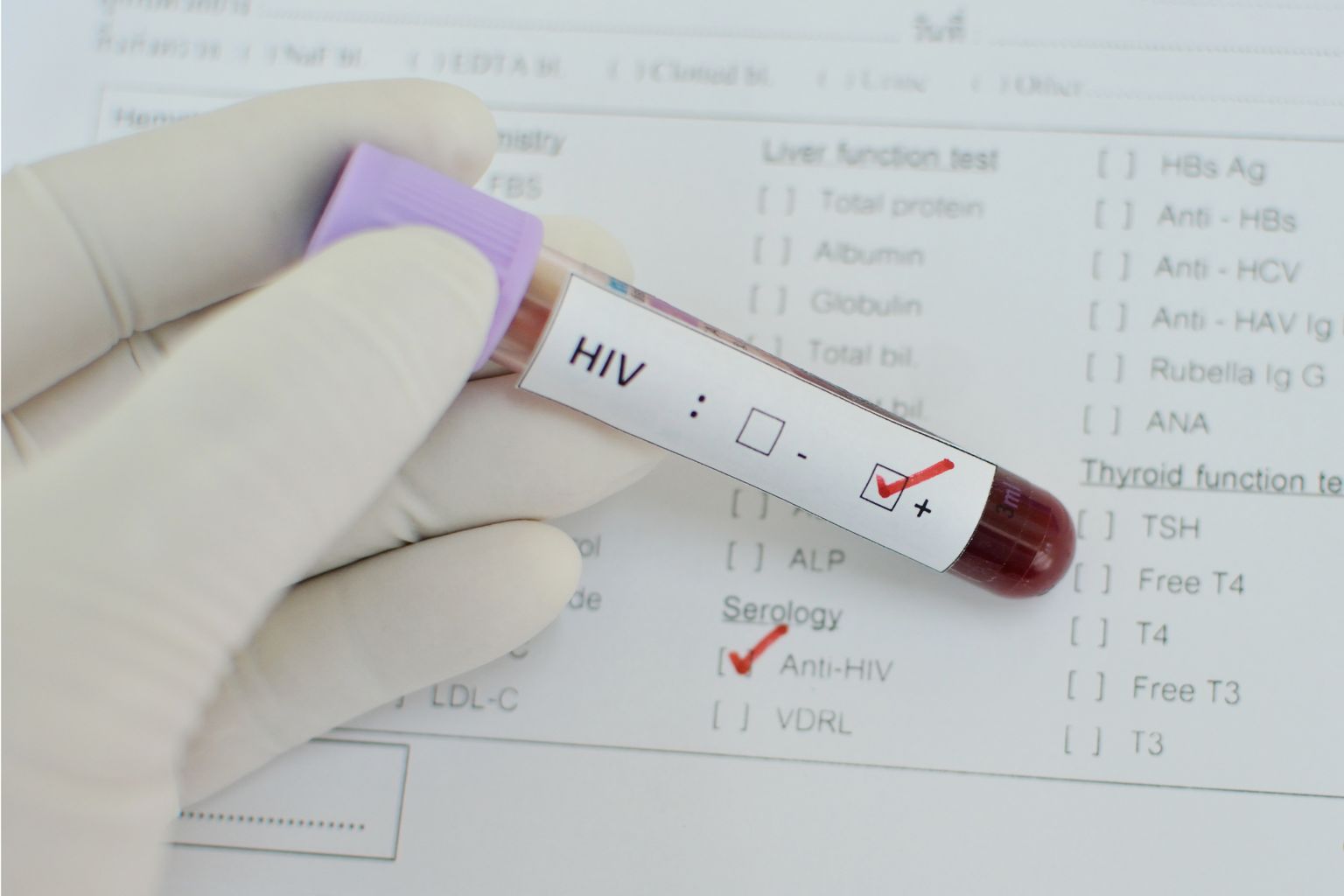HIV positiivne vereproov. Pilt on illustreeriv